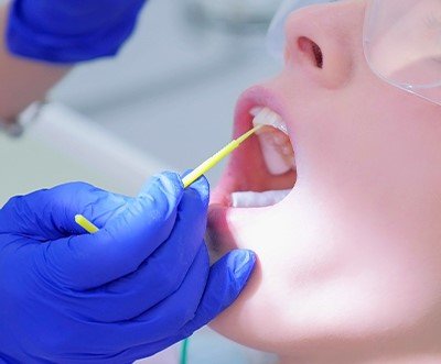 Fluoride treatment helps in fortifying tooth enamel hence extending life of teeth