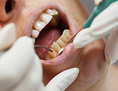 Soft tissue laser is used to eliminate harmful bacteria along the gum line