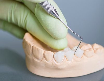 Dental bridges could be used to fill the gap left by 1 to 3 missing teeth