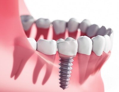 Dental implants can replace an entire tooth both above and below the gum line
