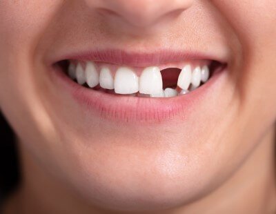 Closeup of smile with missing tooth