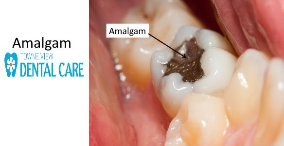 What is the Definition of Amalgam?